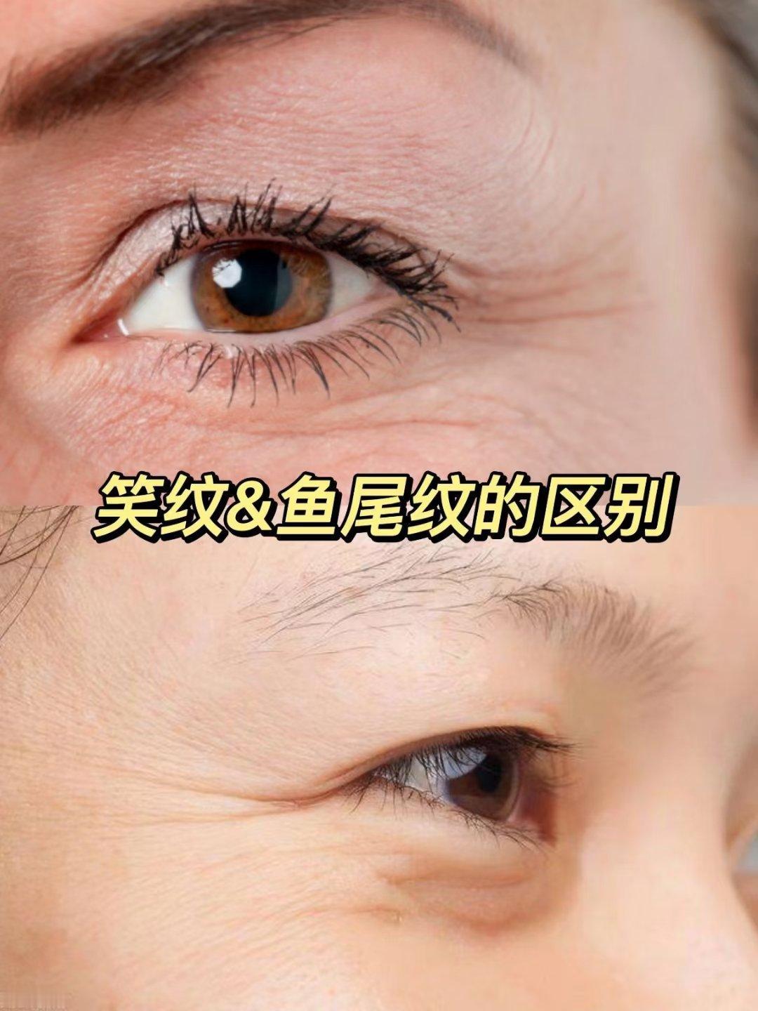 从积极面看，笑带来的情绪价值远超过纹路的影响：
 
- 爱笑是心态开朗的外在表现