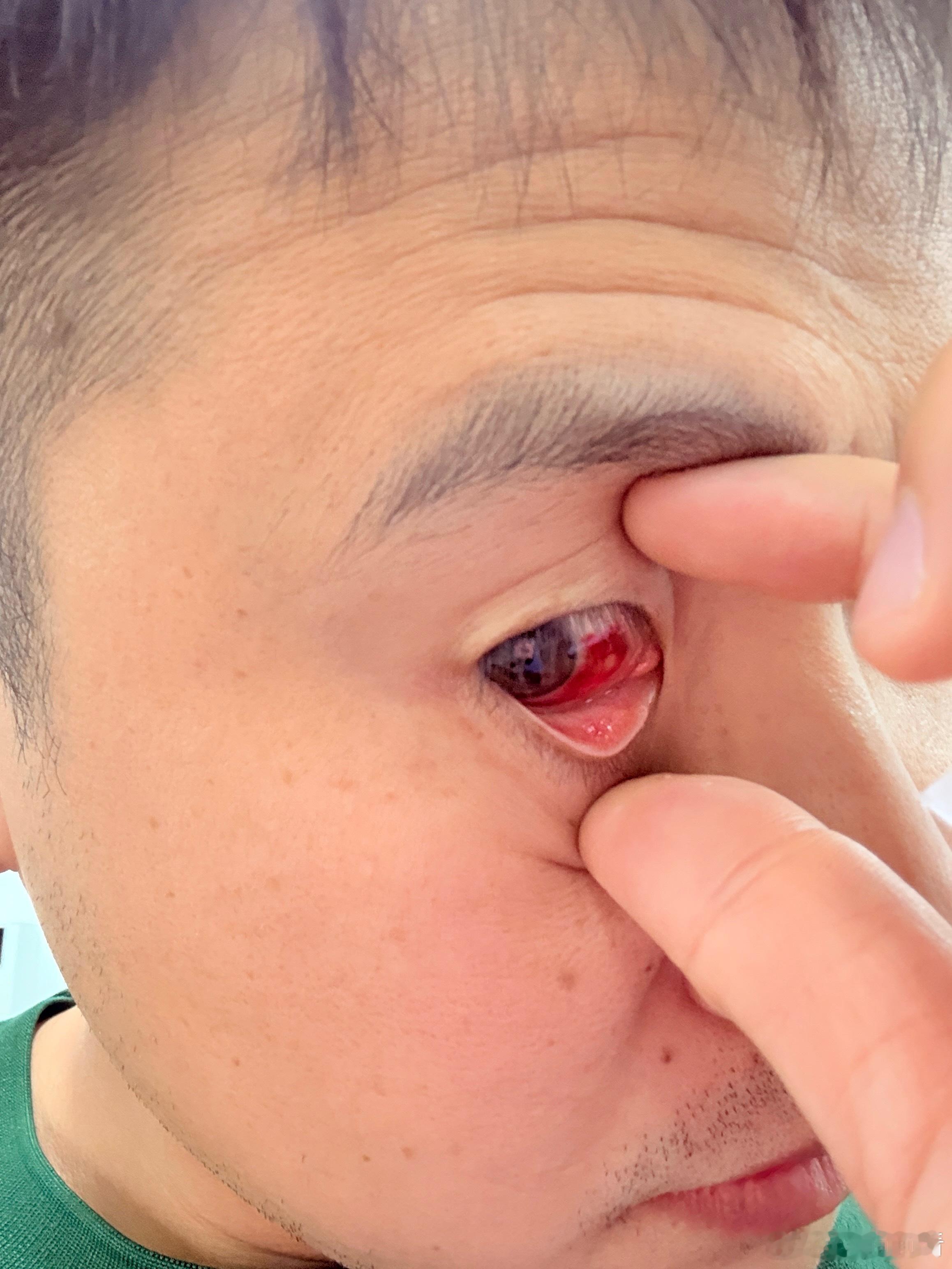 同事发现我眼睛红了，手机拍照一刻，吓着了！眼睛没啥感觉，也不痛，马上问了一下豆包