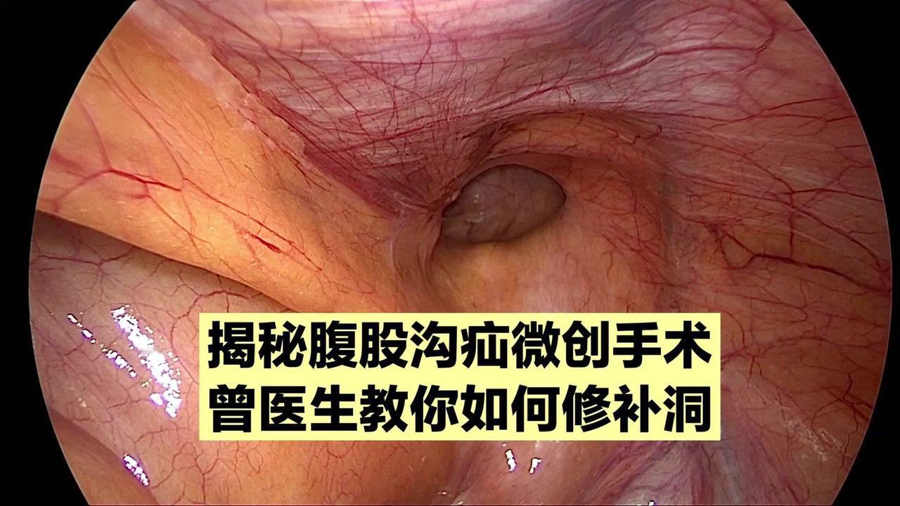 👀肚子上有个洞，肠子会掉里面去，这是腹股沟疝。

👩‍⚕️曾医生来做手术修补