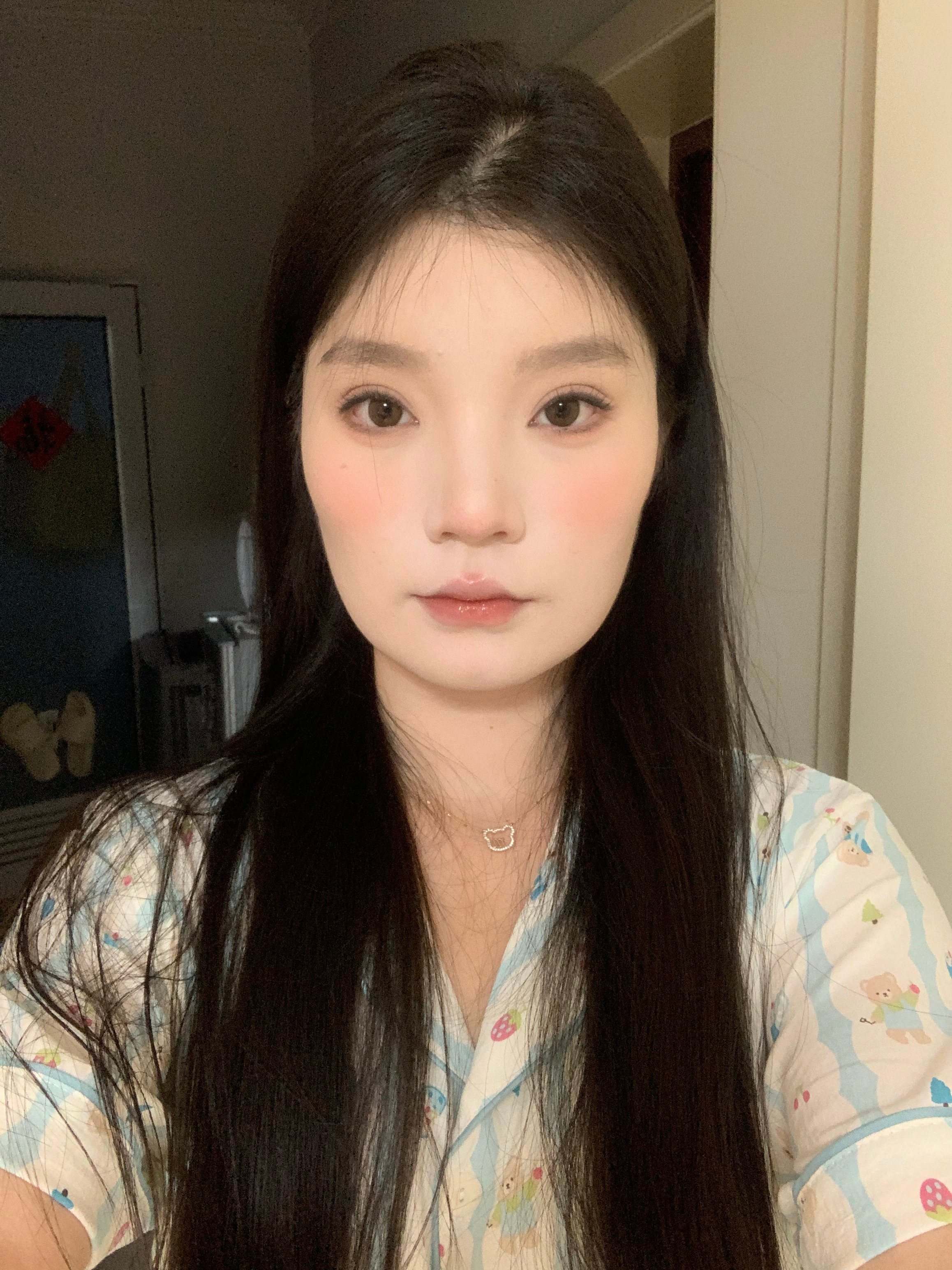 跟大家分享一下我今天的勇士行为我没有敷麻药打了两支玻尿酸哈哈哈哈哈  一只半在颞