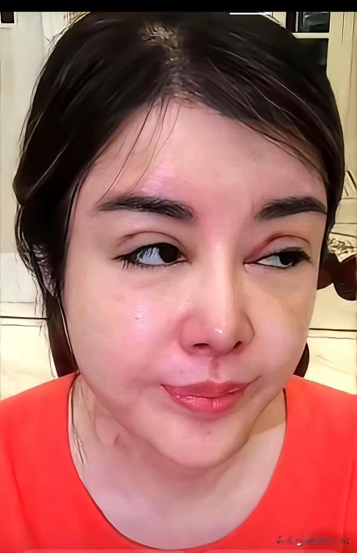 于文红分双眼皮是镰刀割的么？
我咋感觉是她自己照镜子做的呢，
做为头牌美 业大咖