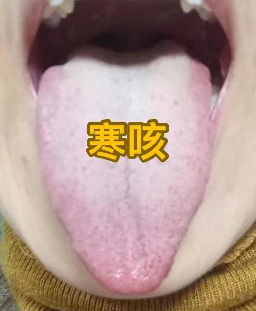 咳嗽千万别乱吃药，分清 寒，热，燥，才是关键，今天一次讲清！

①寒咳——舌苔薄