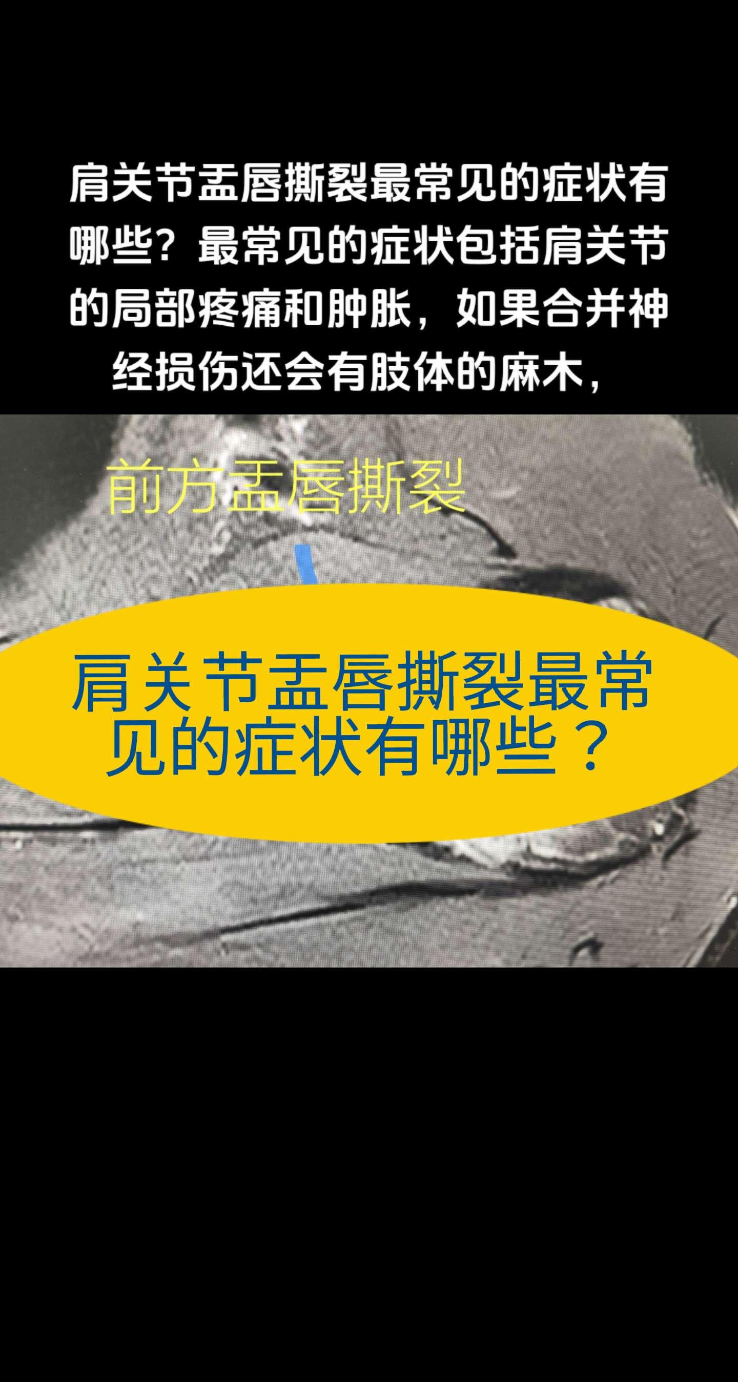 肩关节盂唇撕裂最常见的症状有哪些？