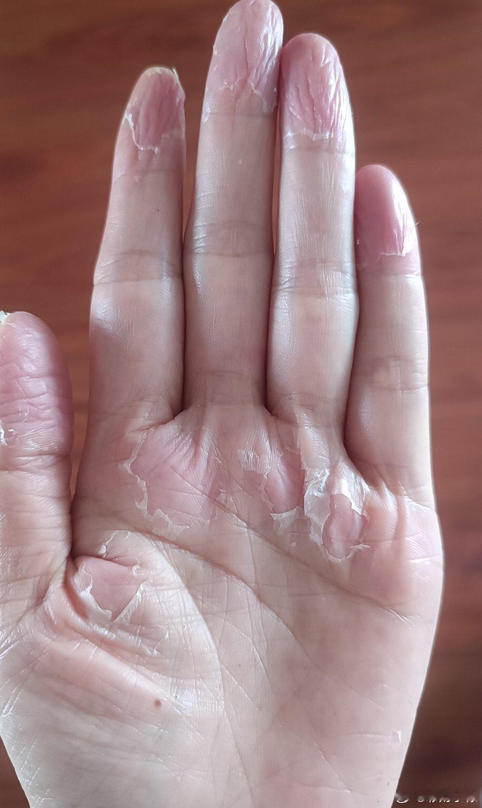 大概半个多月前去吃了一次串串，第二天手指头下面的皮肤就长小水泡，又痒又疼，然后慢