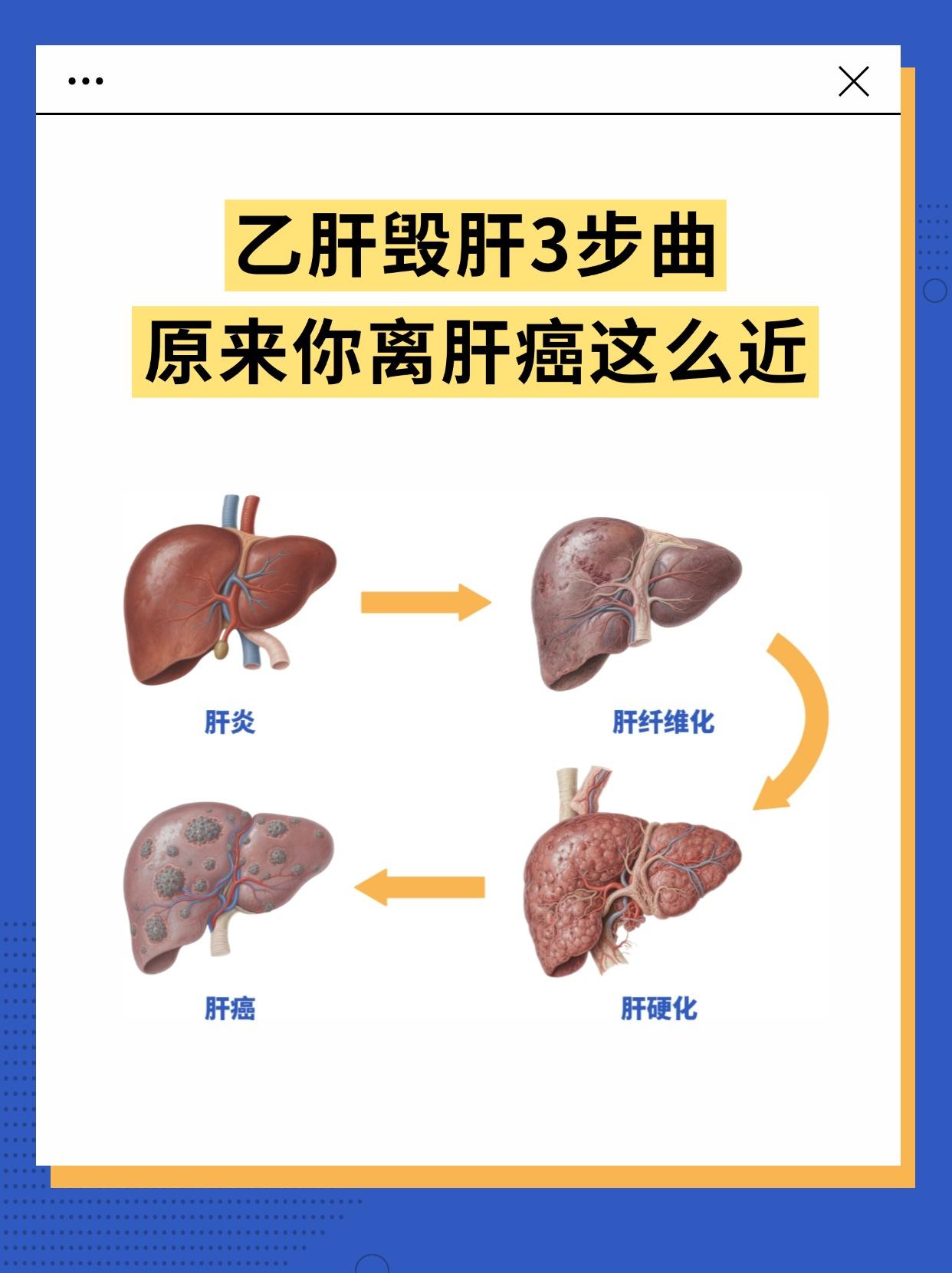 乙肝毁肝3步曲，原来你离肝癌这么近。抖出健康知识宝藏