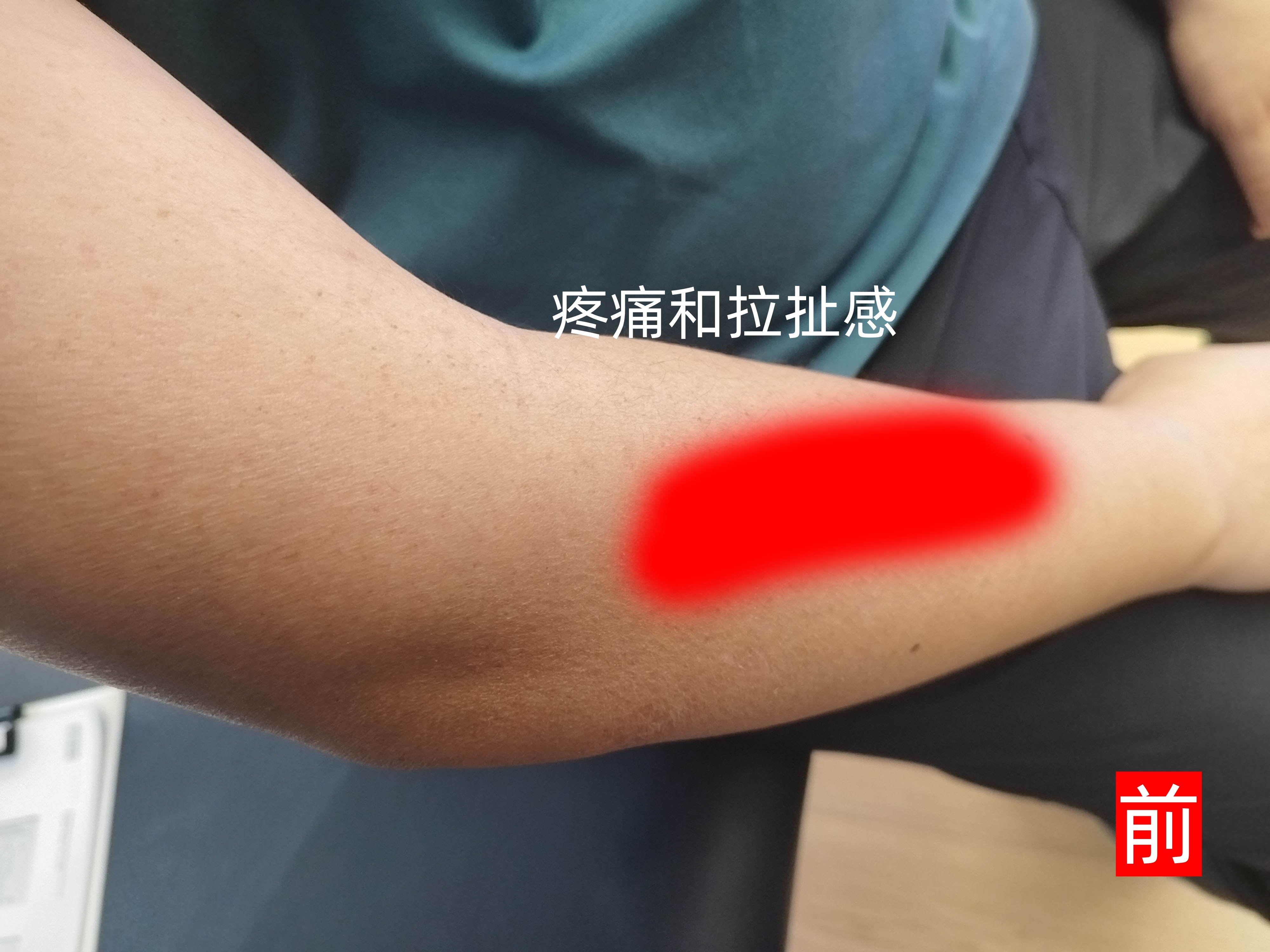 手臂拉伤 为什么我说没有那个活动度，就先别做对应的动作，上海静安门诊这位打羽毛球