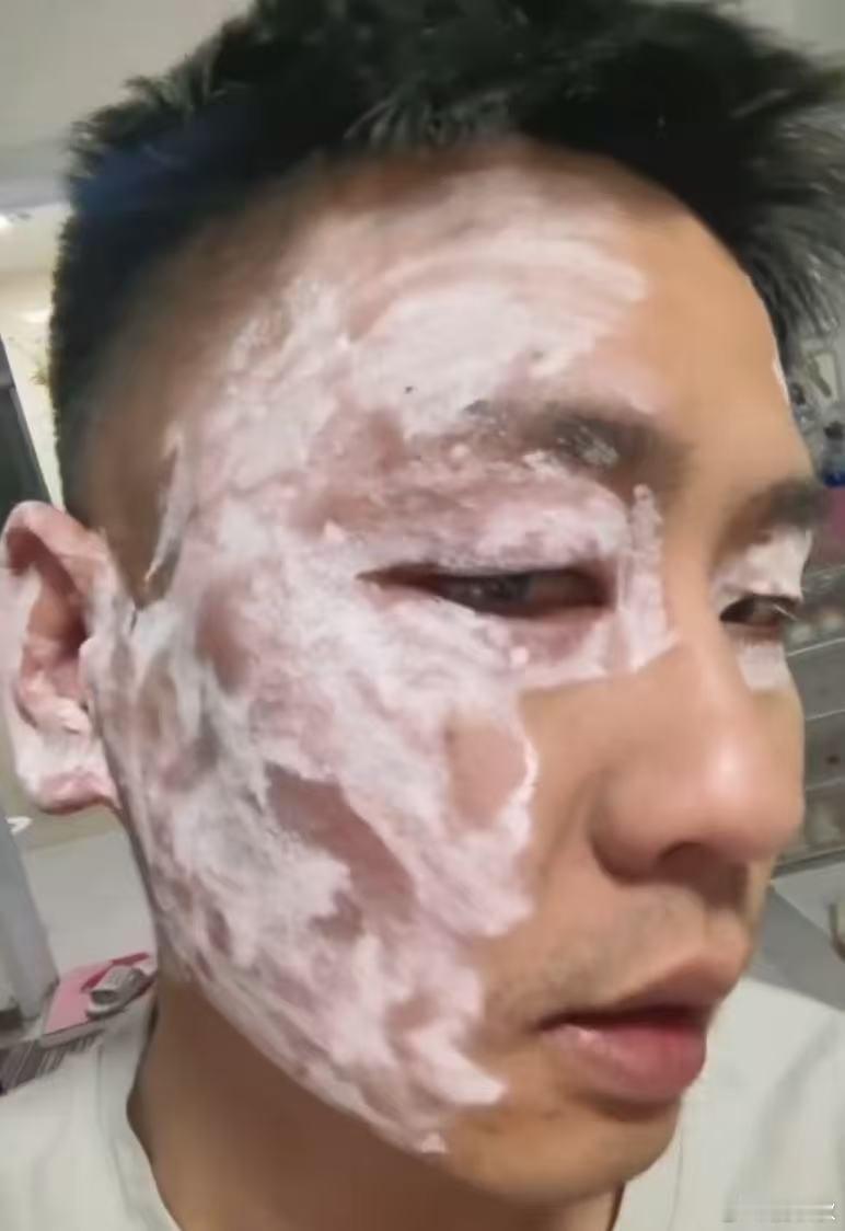 廉价纸巾你敢用吗？外出就餐，用餐馆提供的纸巾擦脸，没想到回家后出现严重过敏，面部