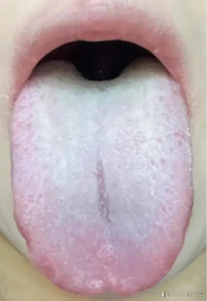 舌白的男同志，听我一句劝吧，别再去吃参苓白术和六君丸了！[泣不成声]

患者主诉