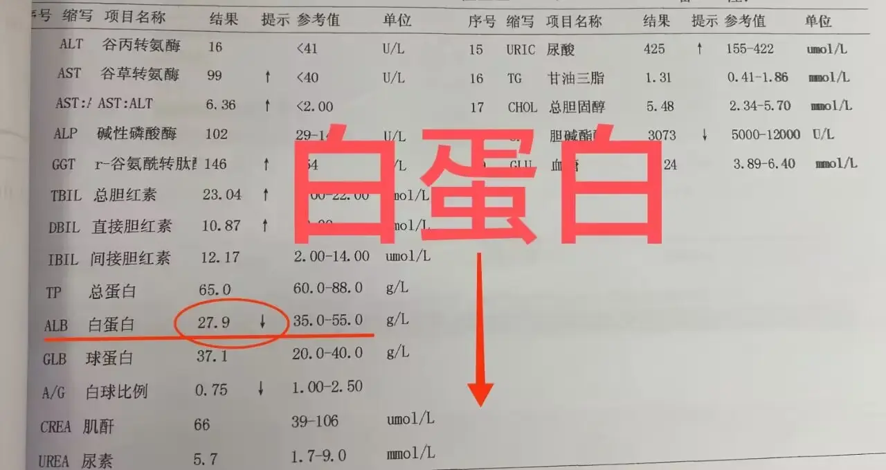 肝功能中这项指标降低一定要警惕！ 今天来讲讲白蛋白这个指标，它主要反映...