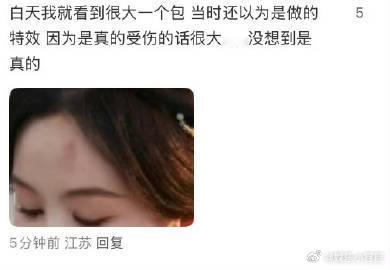 陈都灵额头受伤 从不消费自己的伤痛，只用实力说话。受伤了也坚守岗位，这份执着值得