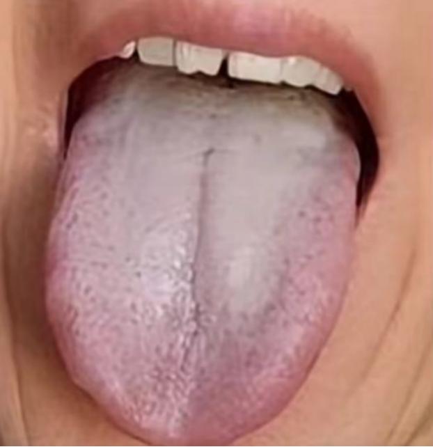 化瘀的最好的方法并不是活血，而是温阳疏肝！
为什么这样说呢？就拿这个患者来说，主