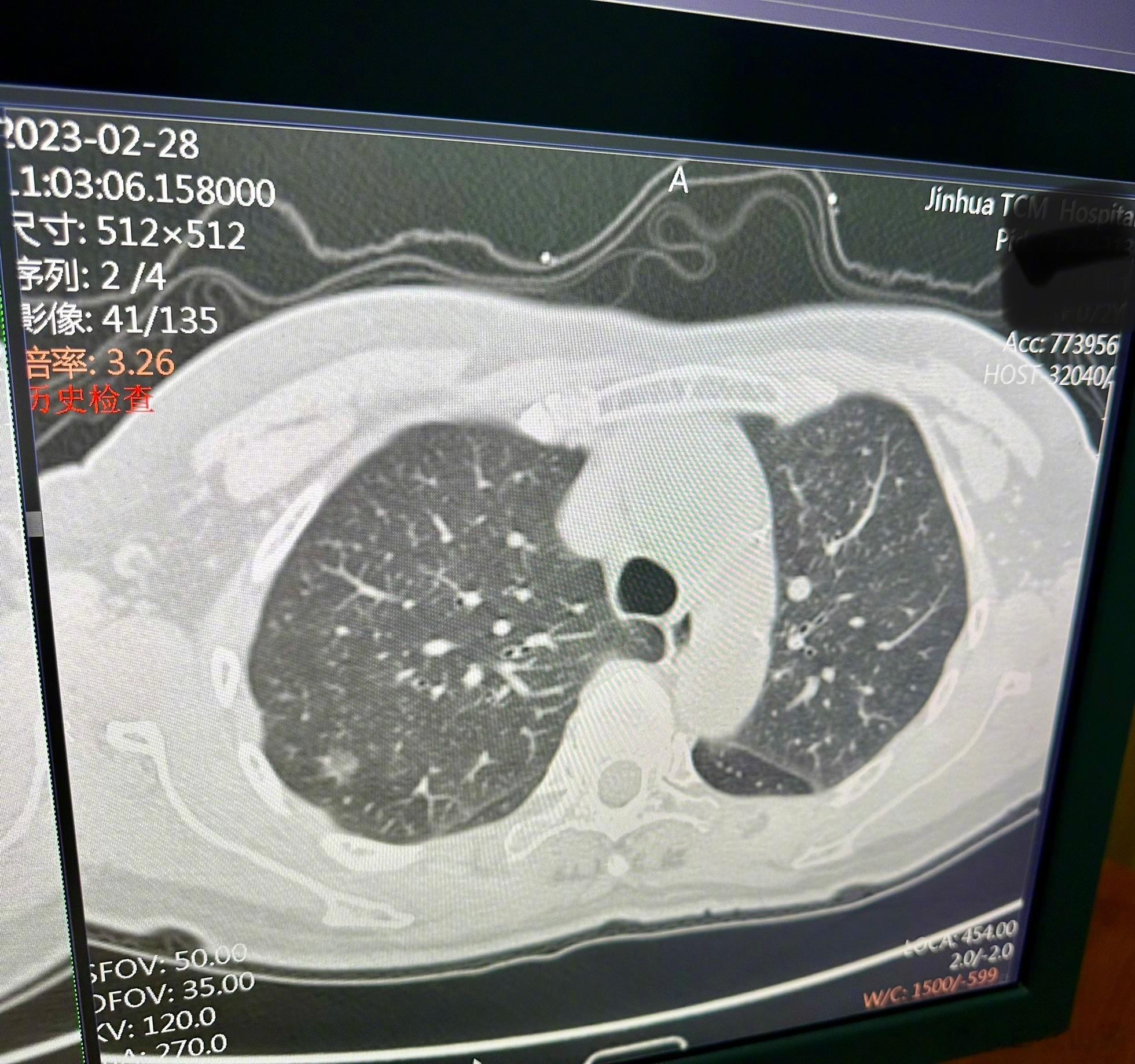 她71岁，20年前，她患了阑尾炎，我给她做了手术。这一次，她心心念念，要她女儿找