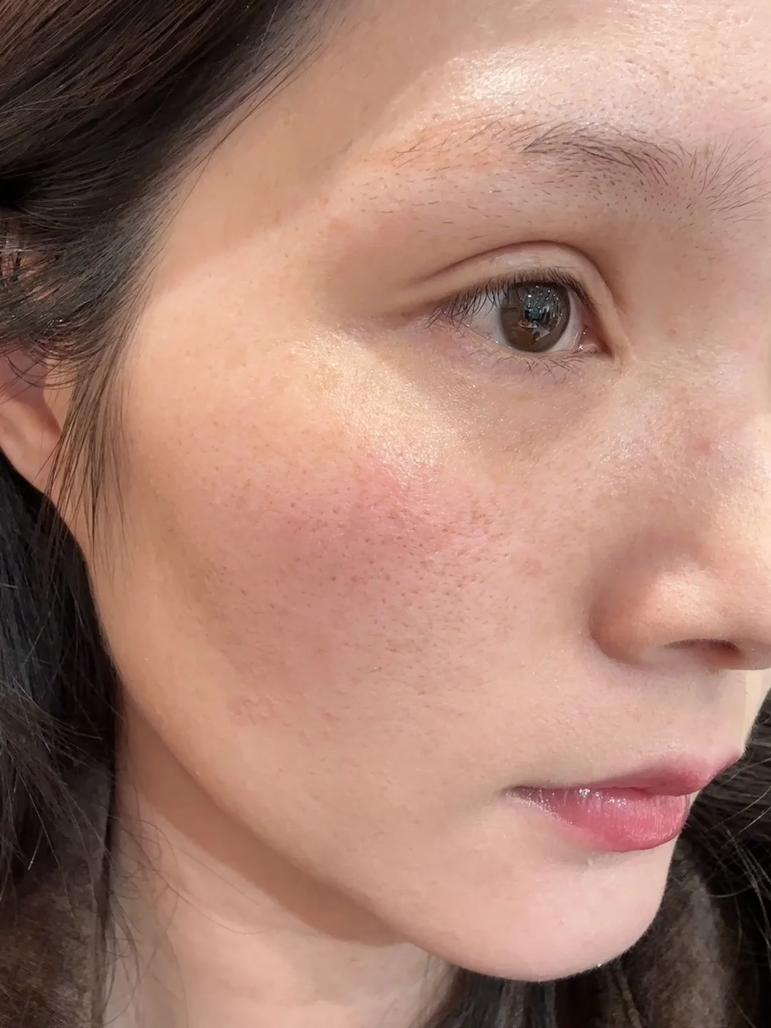 这个毛孔是不是得做个黄金微针啊