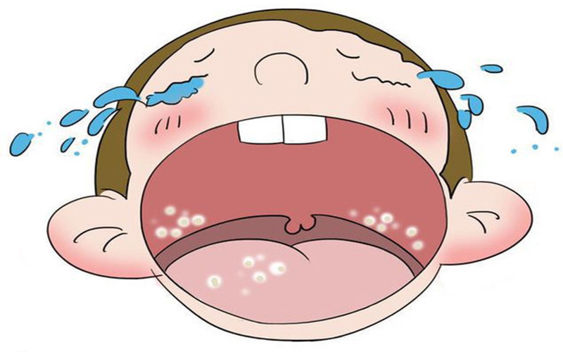 鹅口疮，就是有反复发作的特点。#儿童常见病必备手册# 一般轻度鹅口疮采用口腔清洁