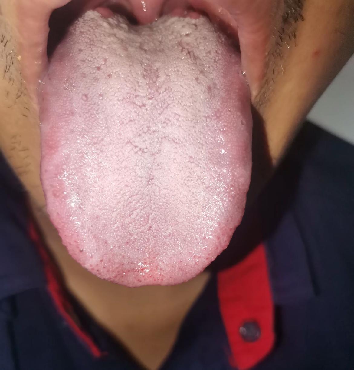 舌苔白腻，布满整个舌头，未必是寒湿[打脸]
你这小伙子，一上来就温补，简直瞎胡闹