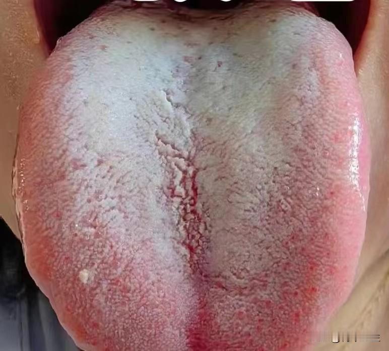 舌苔白腻，舌尖鲜红，听我一句劝，把火也泻了，要不然只助肾阳，怕是承受不住

患者