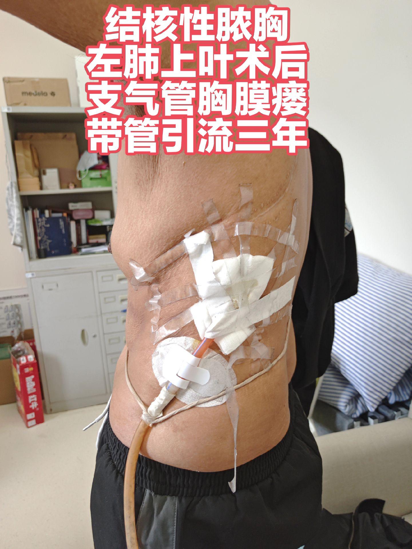 东北小伙左肺结核术后支气管胸膜瘘微创修复。二十出头东北大小伙，原来体重两百多斤，支气管胸膜瘘近三年，身体完全拖垮，继续带管只能消耗衰竭。七院微创修复，一次治愈，还病友健康希望。