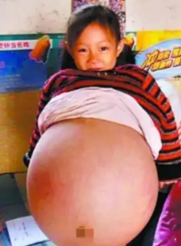 2010年，山西4岁女孩胡云星，肚子超大鼓胀得像孕妇。医生预言活不过三个月，就在