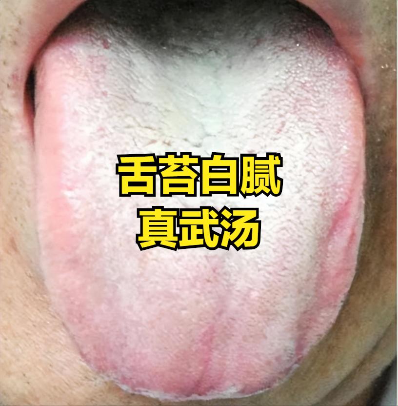 张仲景祛水湿绝妙思路：寒水用真武汤，水热用猪苓汤，水排不出用五苓散！
 
1. 