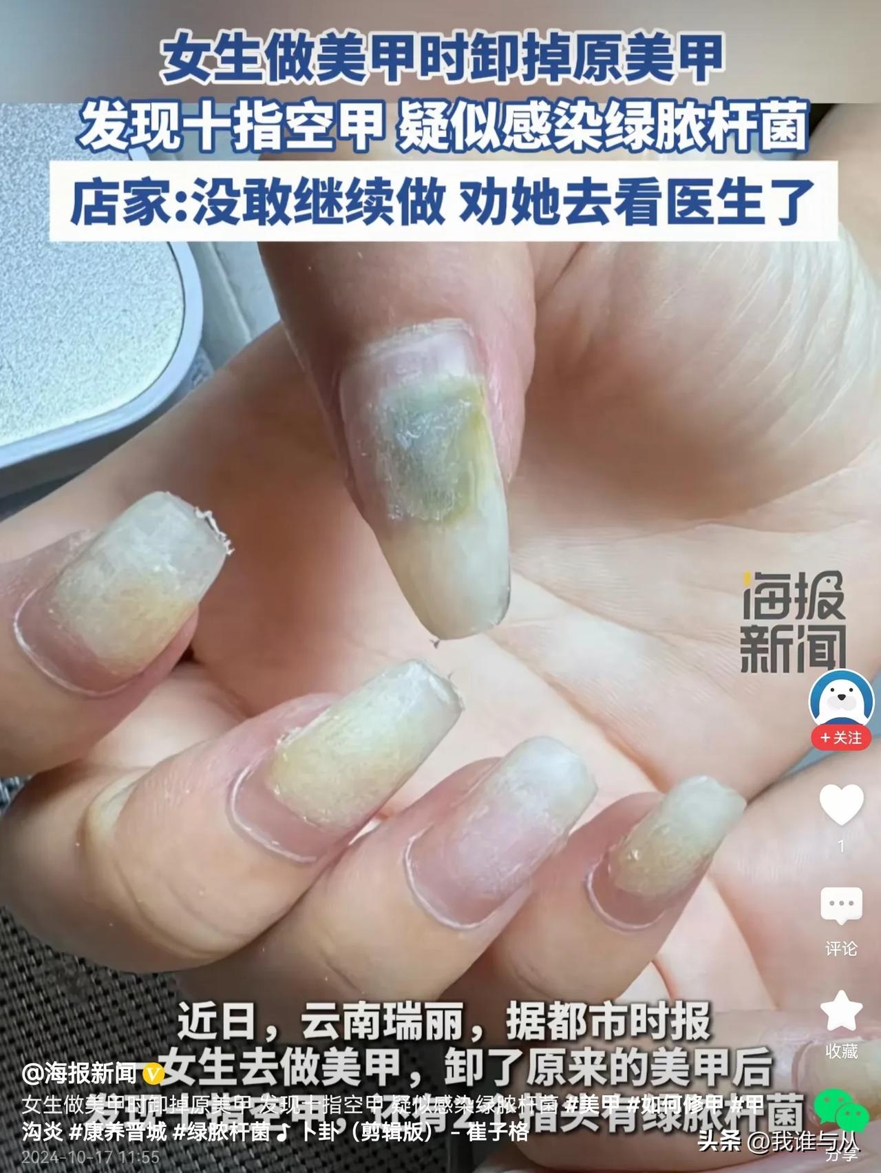 #女子卸甲后发现十指空甲发霉#  你做过美甲吗？看来做美甲还是有危害的。最近有一