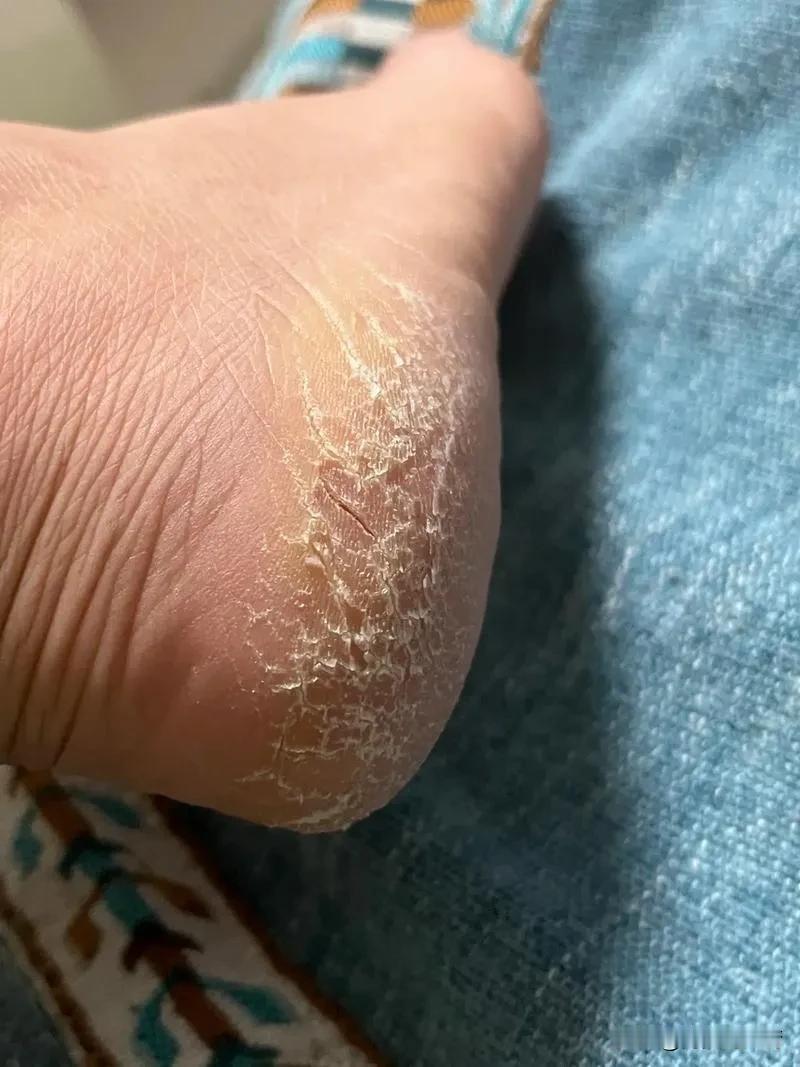 今天跟大家分享一个治疗脚气（脚后跟的角质层特别厚）的方法，本人亲自实验过，绝对好