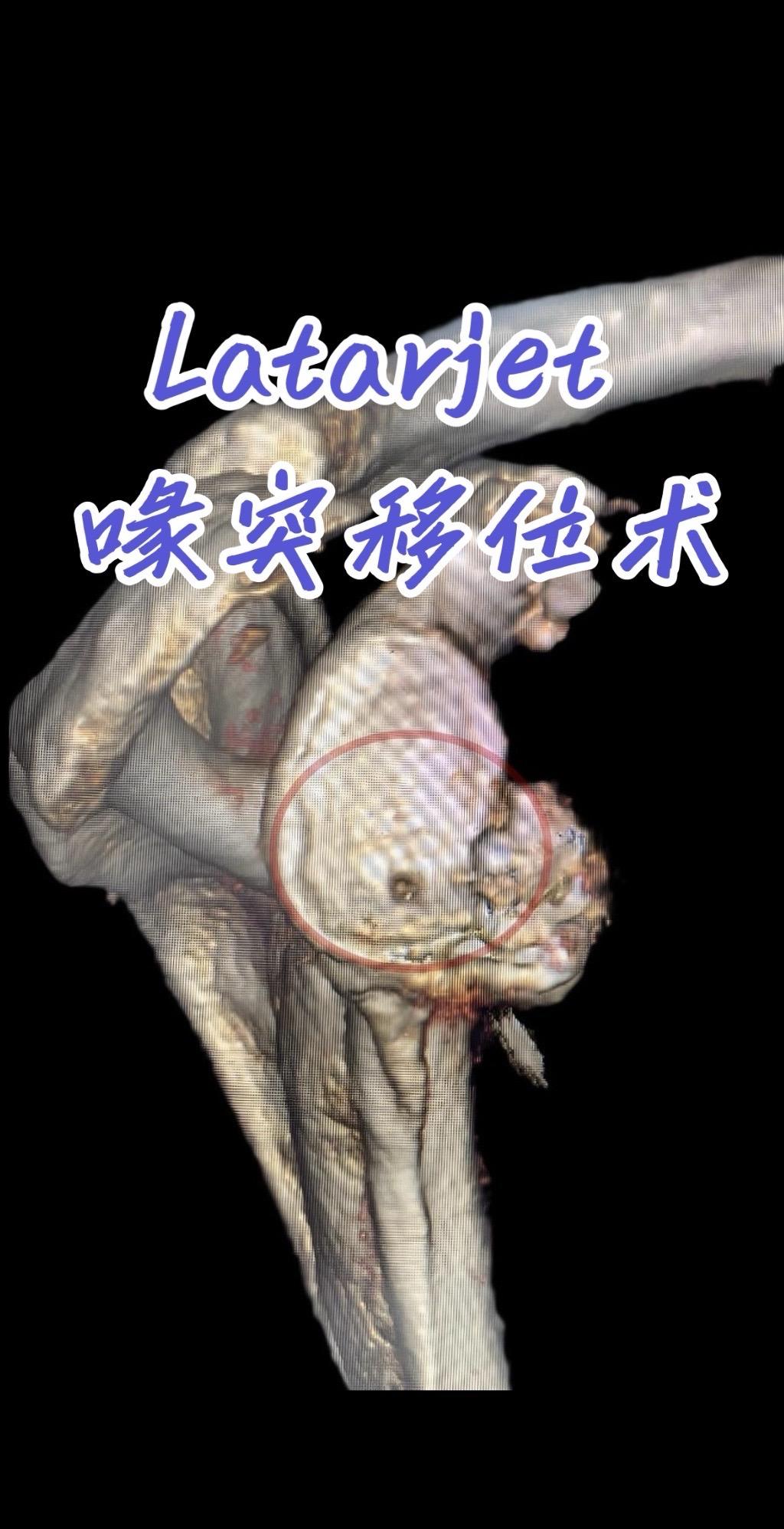 复发性肩关节脱位。喙突移位术（Latarjet）治疗复发性肩关节脱位。