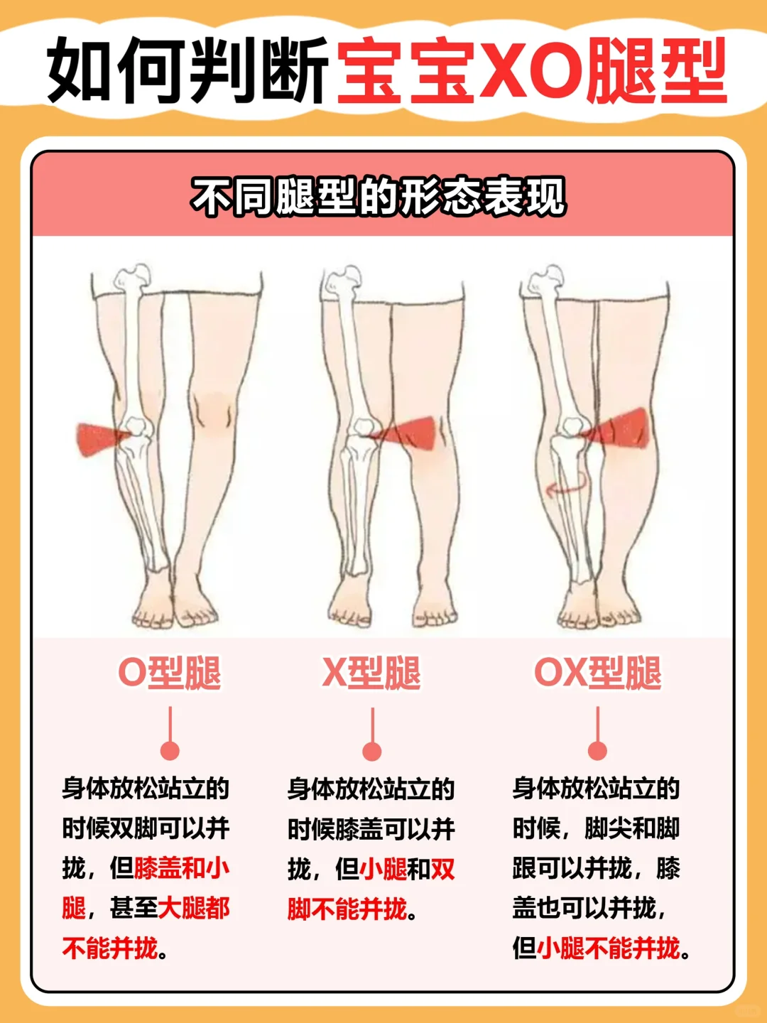 如何判断XO腿型‼️一张图看懂💁‍♀️