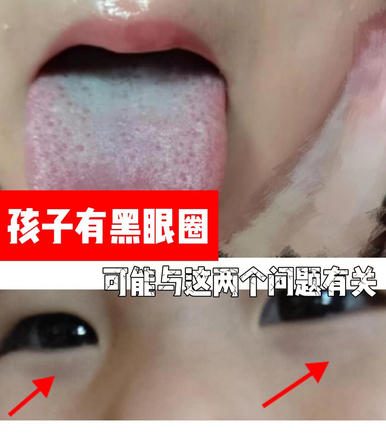 家长求助：孩子从晚上9点睡到次日7点，睡眠充足，为什么会顶着两个大黑眼圈？
 
