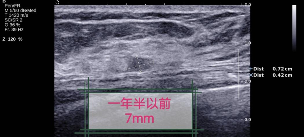 一年半长大一倍（乳腺癌）女，53岁。
一年半之前发现乳腺结节7mm，患者选择随访。
一年半之后长到12mm。选择手术。
结果为浸润性导管癌。
因此，随访很重要。