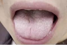 这为患者主要是腹部易胀，大便糖稀，畏寒怕冷，身体困重，关节酸楚来看的。从整体舌象