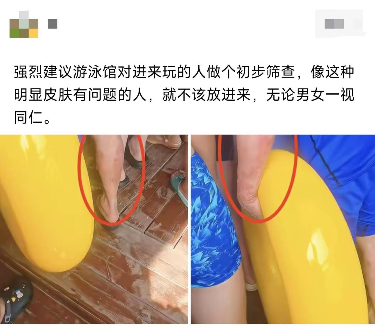 也许人家只是皮肤干燥，别太歧视了吧？