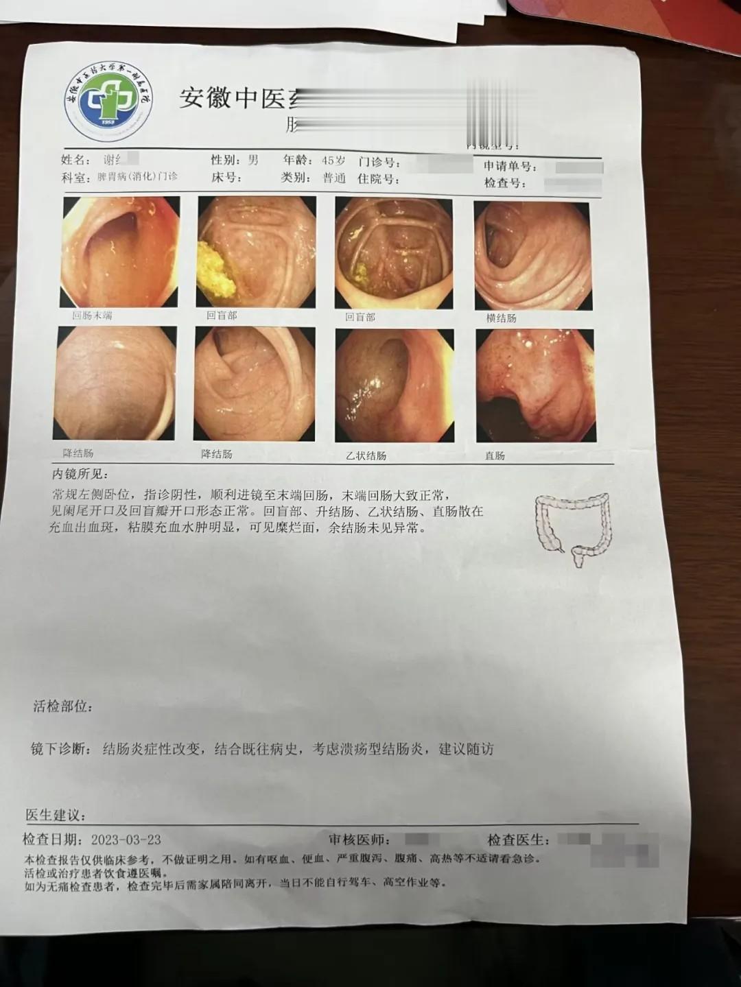 8 年溃结反复不愈？中西医结合，肠镜终获 “基本缓解”！  这位患者确...