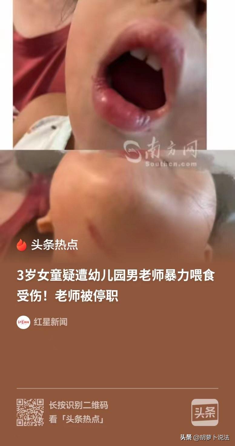 中山，三岁的小女孩在幼儿园不爱吃饭，男老师便暴力的喂她，结果把颈部和嘴唇都弄伤了