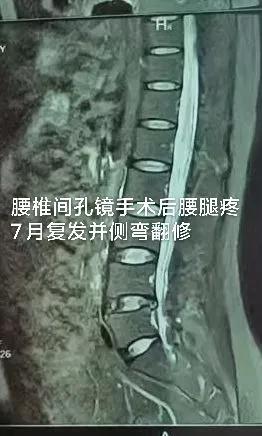 腰椎间孔镜手术后腰腿疼7月，椎间盘突出复发并侧弯，微创内镜翻修