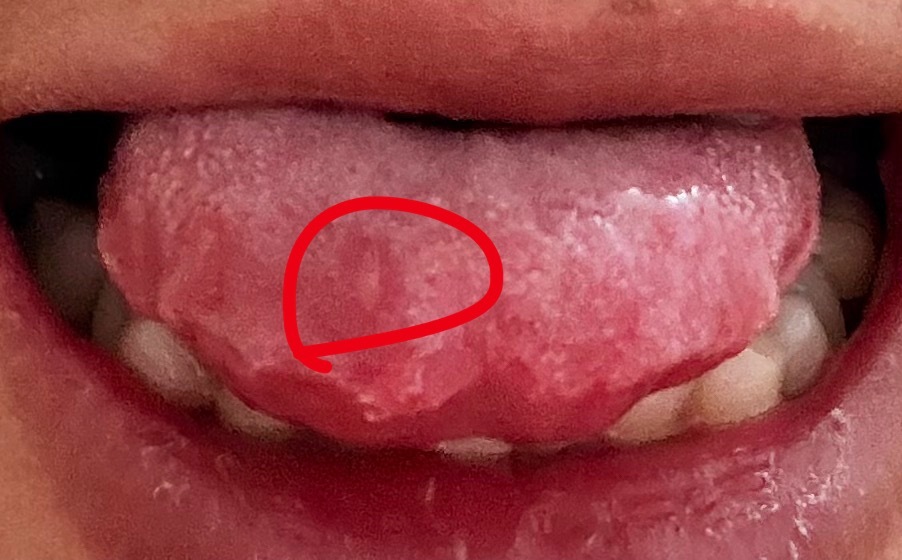 这趟暑假旅行主要以发掘各地美食为主，结果就是舌头上长了个溃疡你敢信，意可贴都不好