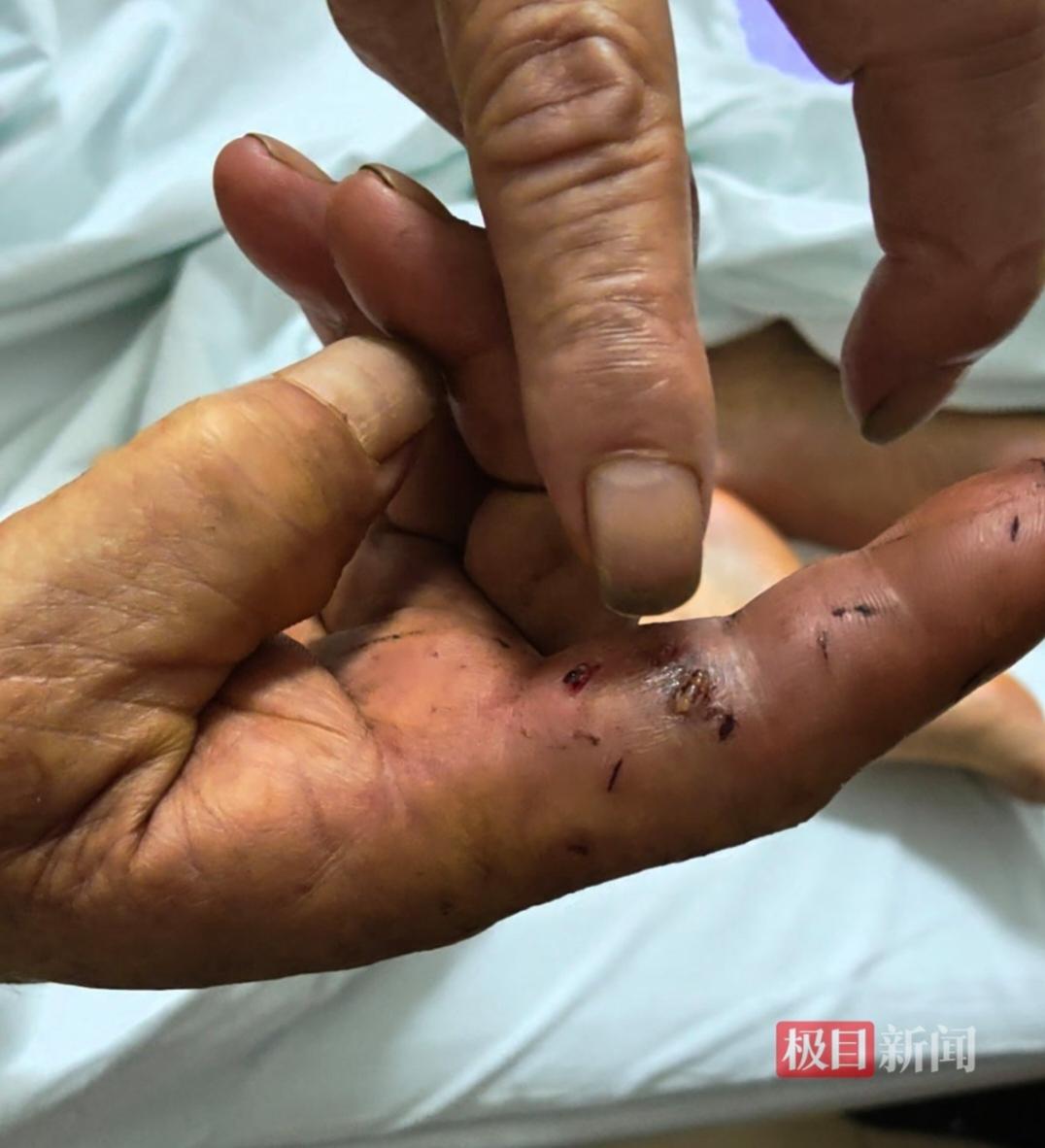 洪水来袭，毒蛇出逃，村民被咬后用嘴吸毒自救，这方法真的对吗？
近日，受台风“美莎