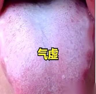 伸出舌头，照照镜子。
看看你舌头边上，有没有一圈小牙印？
别小看这圈印子，这玩意