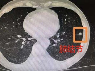 定期体检和有不适症状再去检查，你知道有什么区别吗？咱们通过两个病例来看...