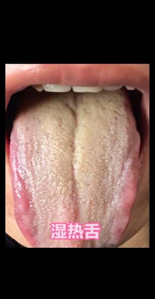 因为当体内湿热过重时，会不停的熏烤舌头，这时就会导致舌面舌苔变黄，而且舌质发红