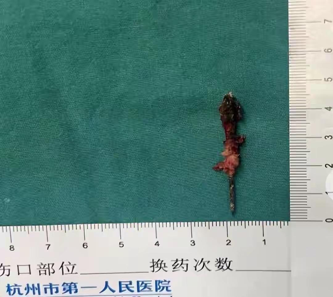 17岁少年参军体检惊现胸腔缝衣针，暗藏16年险致命，父母悔恨不已

安徽17岁小