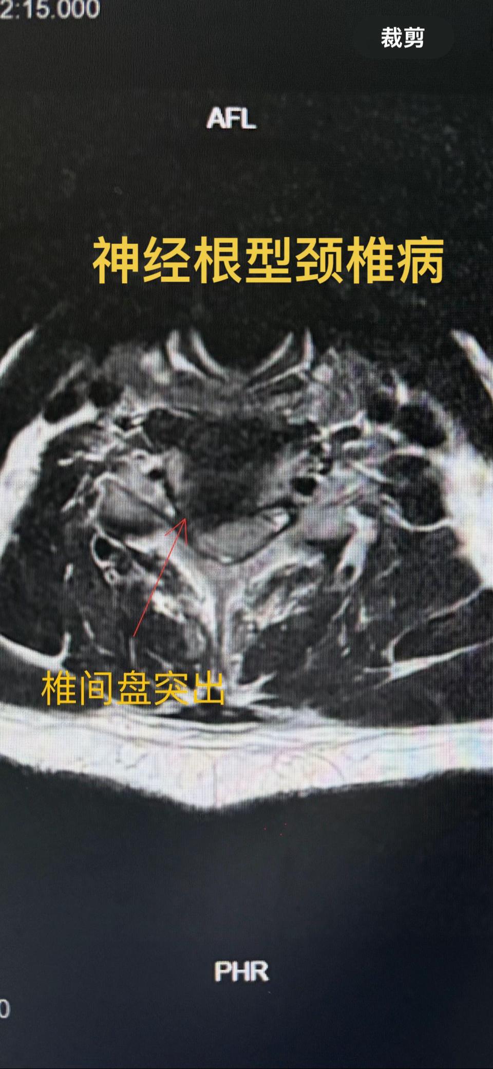 神经根型颈椎病。一例典型的神经根型颈椎病，一侧上肢剧痛2日未合眼。术后...