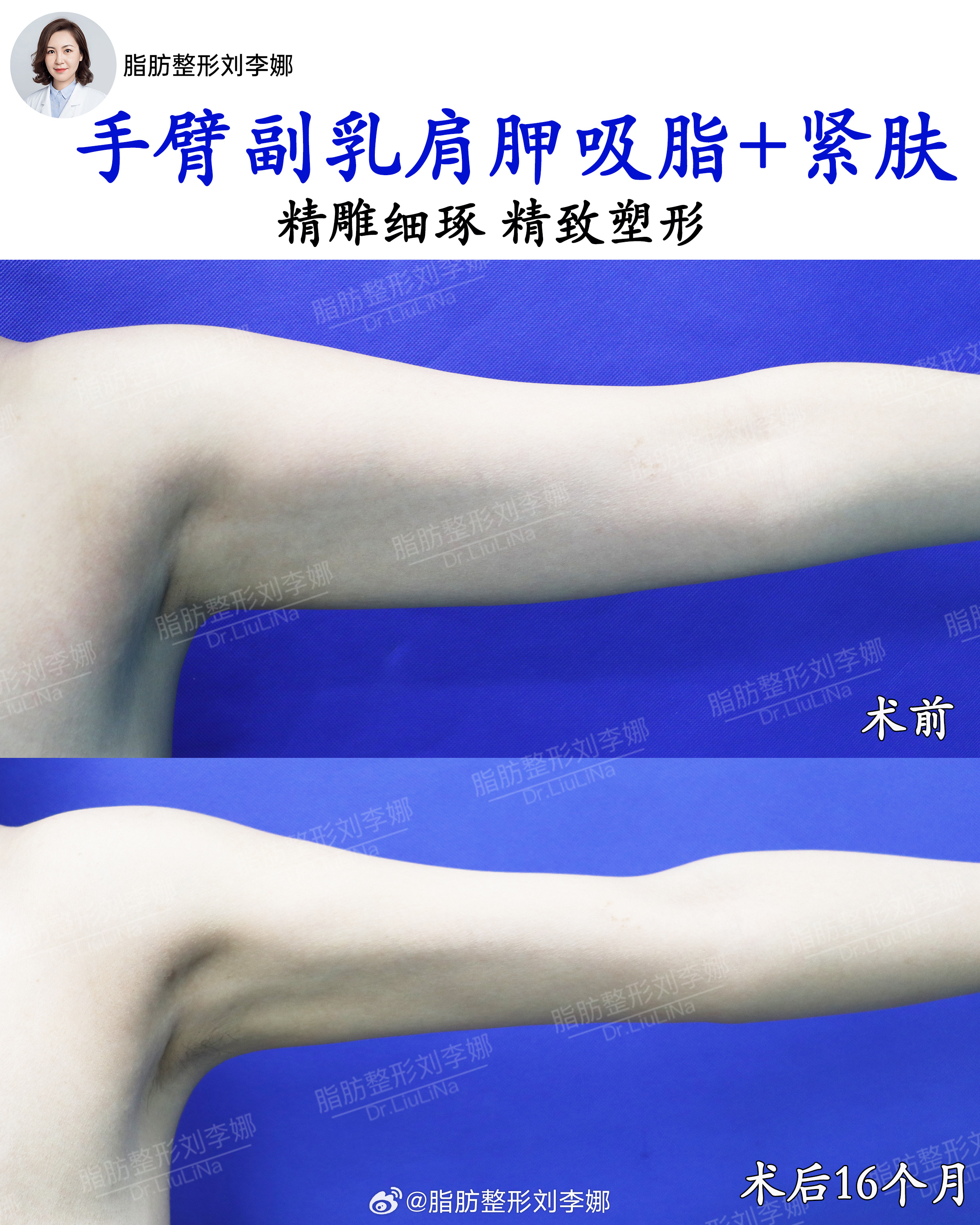 脂肪整形刘李娜手臂吸脂手臂抽脂 术前比较明显的手臂粗壮，且伴有明显的皮肤松弛，拜