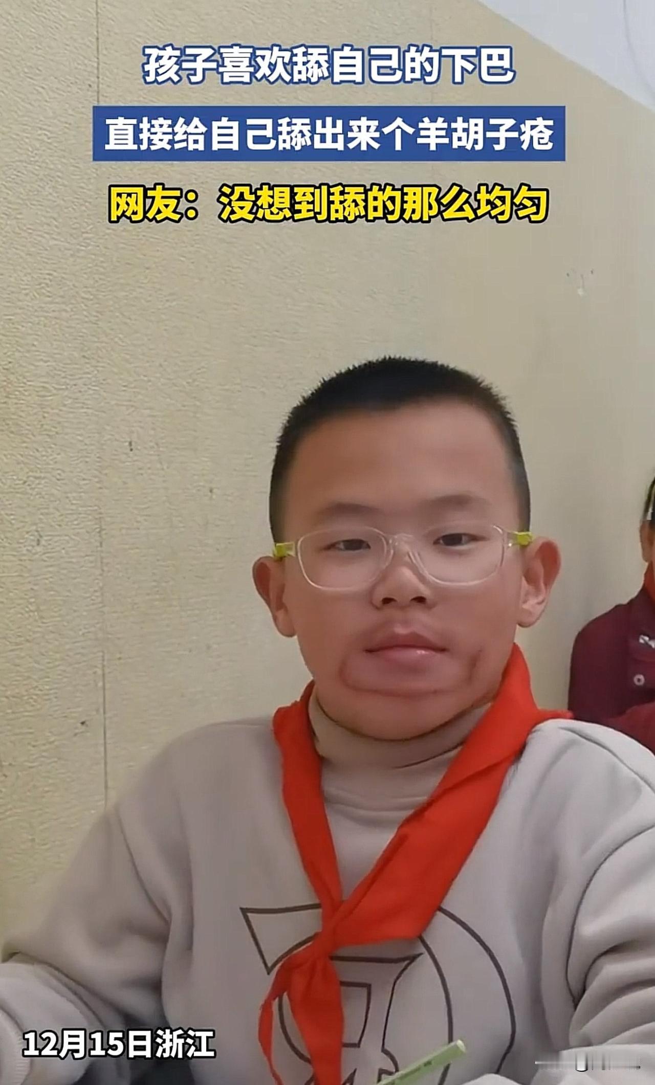 #孩子给自己舔出个羊胡子疮#“笑哭！”浙江一位小男孩喜欢舔自己的下巴，没想到直接