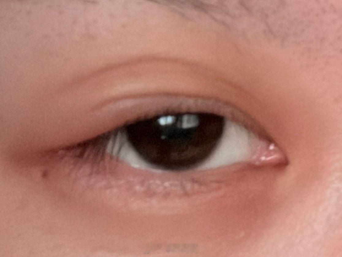 早上起来右眼眼眶疼，到晚上已经肿起来了，现在眨一下眼半张脸疼……咋回事[跪了]睡