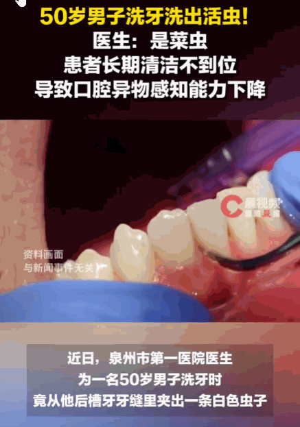 病从口入！福建泉州，一50岁男子是重度牙周病患者，还患有糖尿病并长期吸烟。医生在