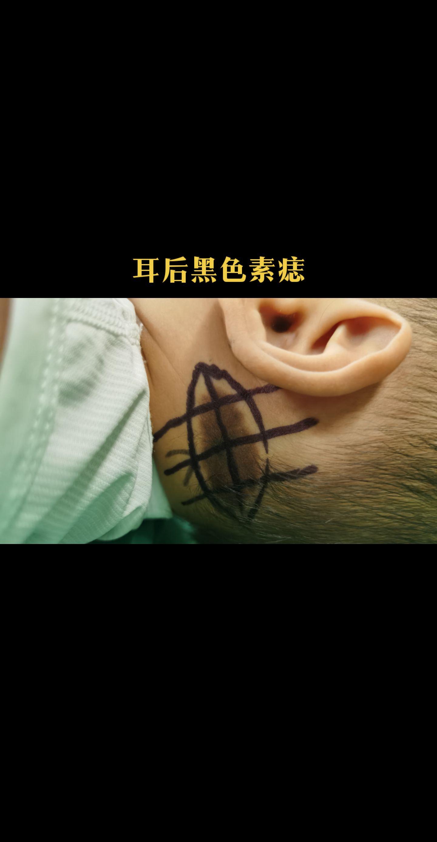 患儿耳后先天性黑色素痣，建议分次切除，患儿家长要求一次性切除，为了减轻...