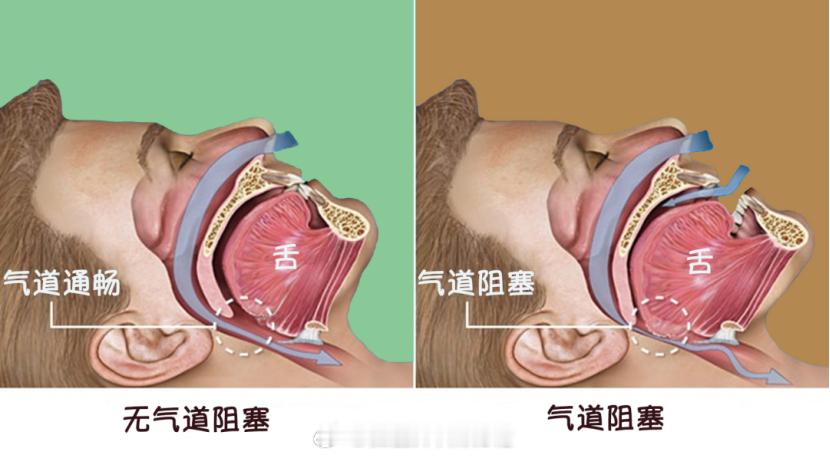 #睡个好觉享受开挂人生# 原同事大胖惊恐地说再也不敢开车上班了，最近一周发生两次