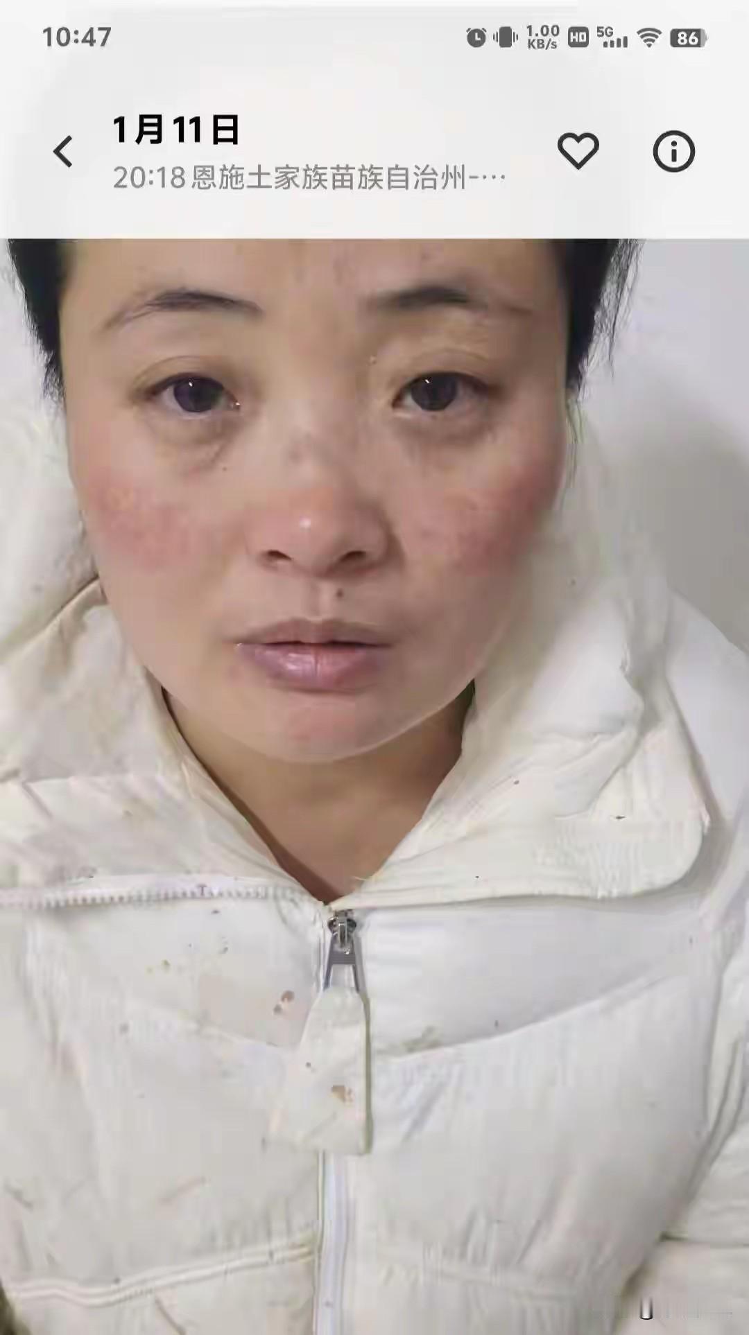 被家暴13年后失禁患癌，她将丈夫送上法庭，丈夫回应称：家暴指控片面，不属实。
 