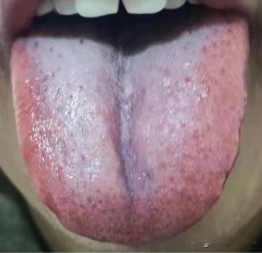 舌头一劈两半，贯穿整个舌头，欲望强，行事差，再不管神仙难救！

这个患者30出头