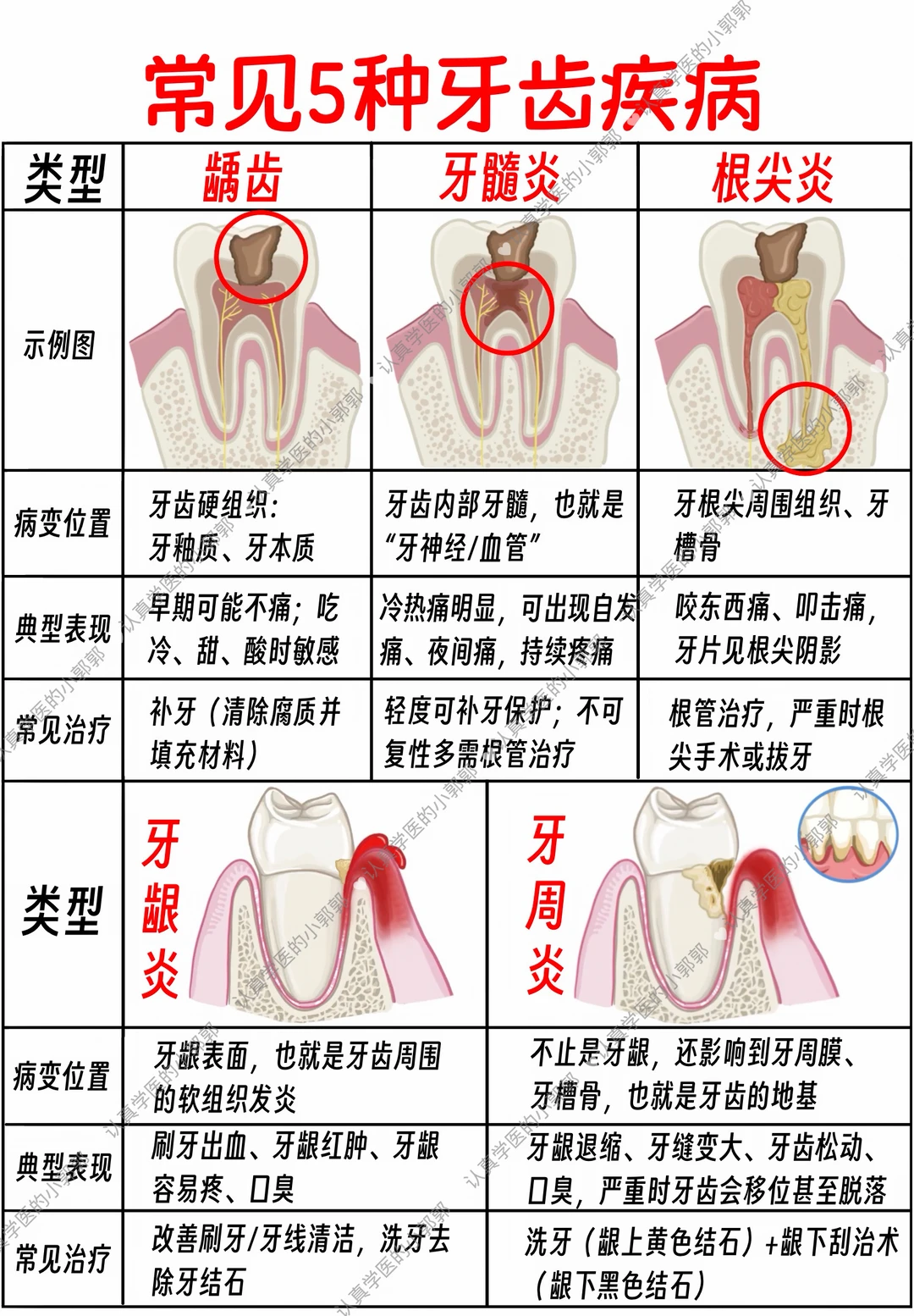 一图看懂常见5种牙齿疾病